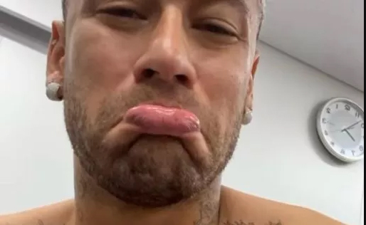 Neymar Mostra Hematomas No P E Faz Cara De Choro Em Vdeo Publicad